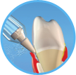 Reiniging en behandeling van parodontale pockets